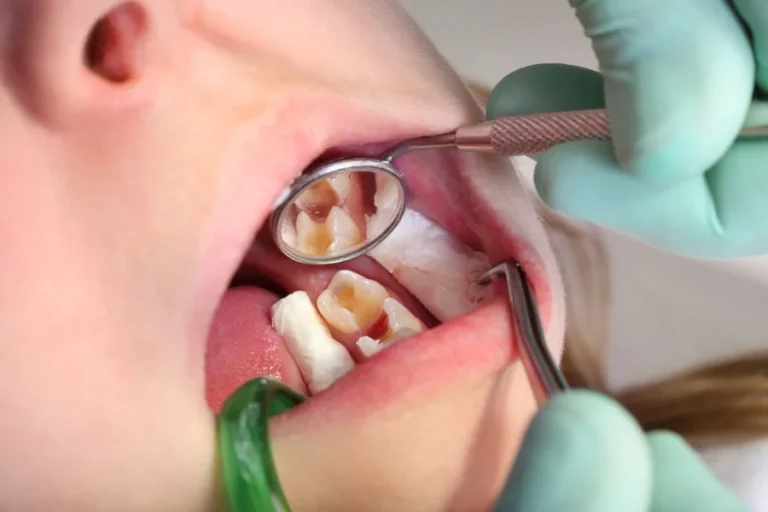Understanding Fillings, Crowns, And Other Common Dental Procedures Dental Procedures