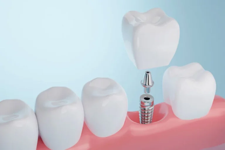 Why Periodontal Health Is Essential For Long Term Implant Success